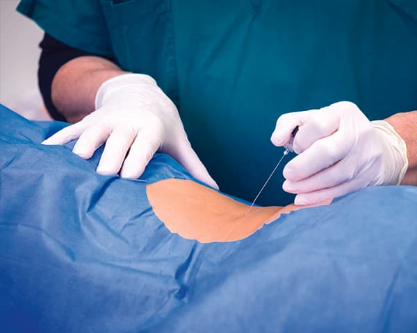 Infiltration facettaire ou intra-articulaire