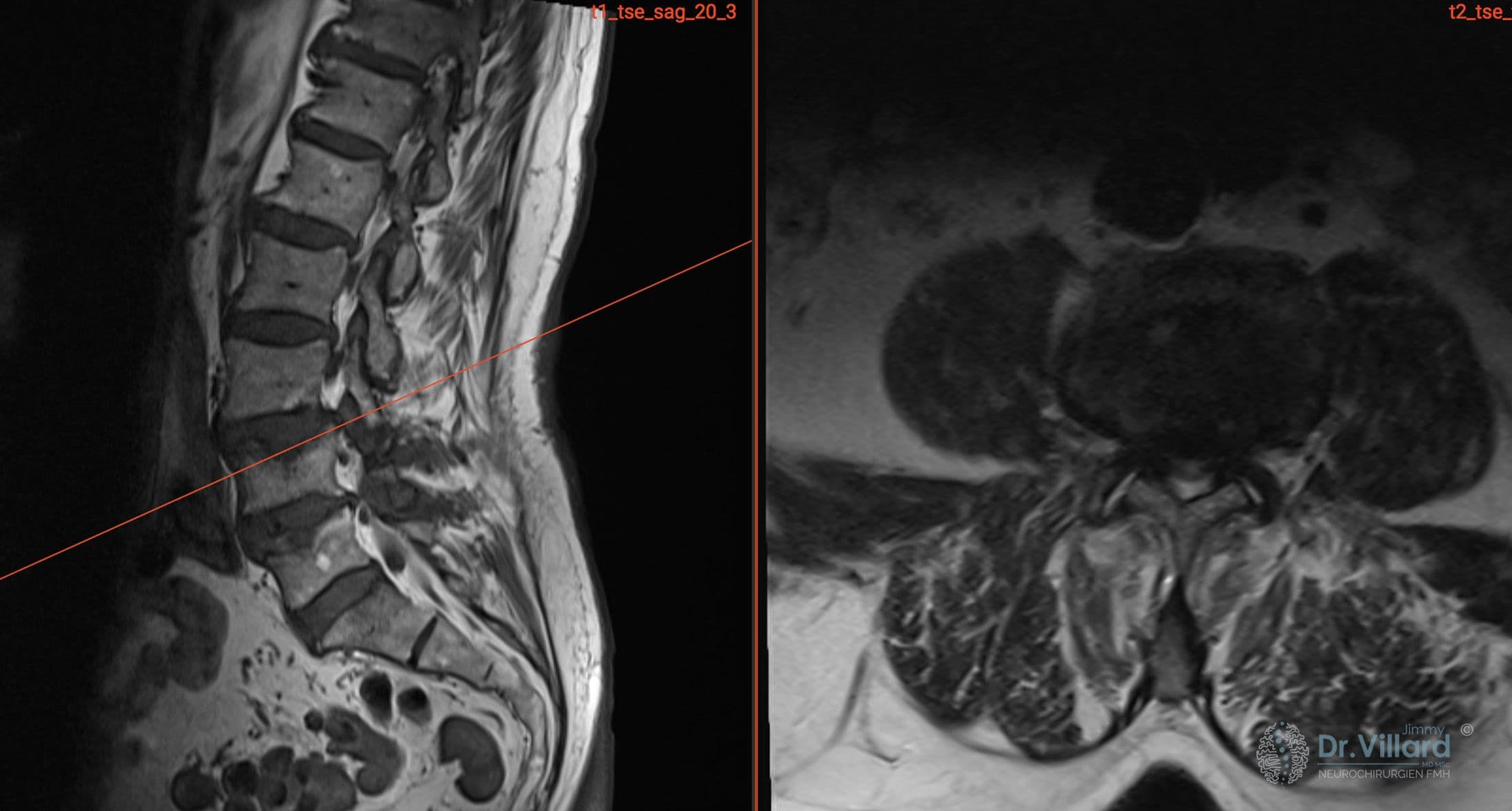 IRM d'une double fracture de L4 et L5
